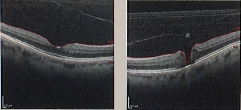 Optical coherence tomography (OCT) of macular hole on the right pupil.