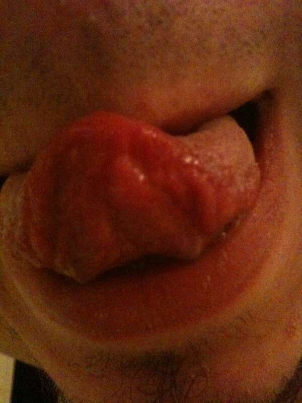 This is a picture of a granular cell tumor