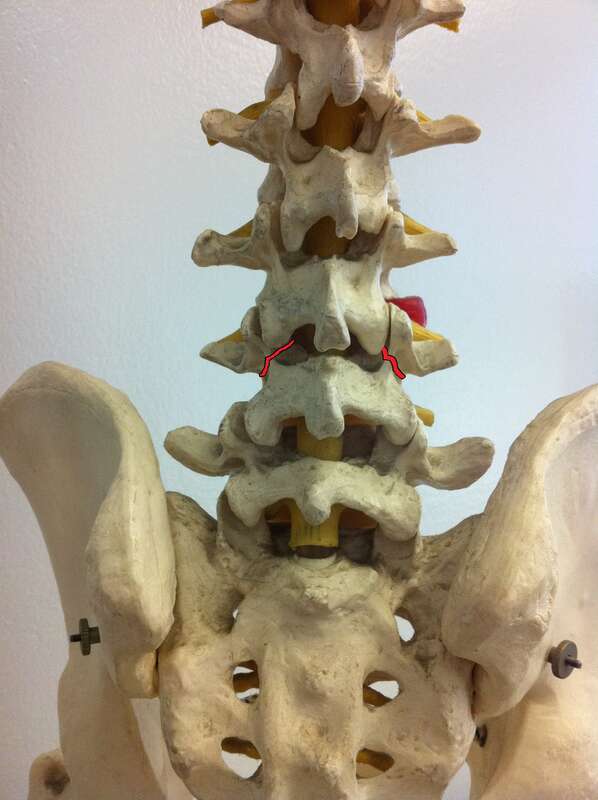 Spondylolysis lumbar pain